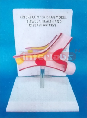 DISEASE ARTERY MODEL